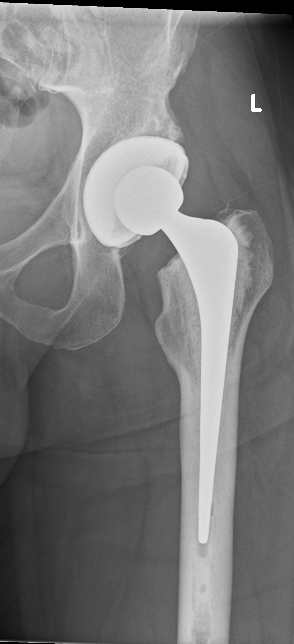 after total hip replacement