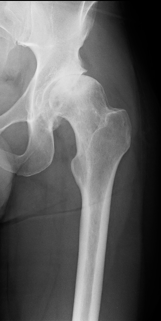 before total hip replacement