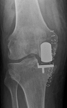 After partial knee replacement