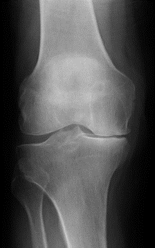 Before partial knee replacement